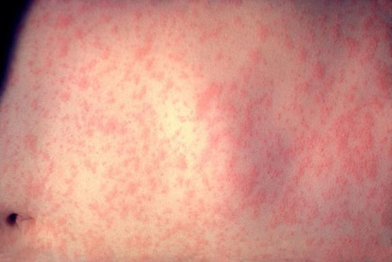 La erradicación del sarampión, más lejos de alcanzarse según la OMS