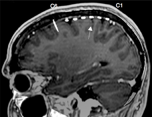 Why Zapping the Brain Helps Parkinson’s Patients