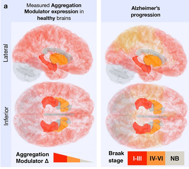 New research hints at pattern of Alzheimer’s spread in the brain