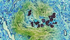 [:es]A new study is changing how scientists think about Alzheimer’s disease[:]