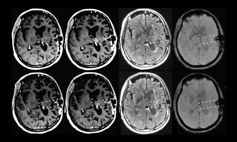 [:es]Esta máquina predice el riesgo de alzhéimer con más precisión que los médicos[:]