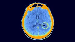 [:es]Cancer-genome study challenges mouse ‘avatars'[:]