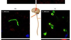[:es]Investigadores españoles relacionan la ELA con hongos en el cerebro[:]