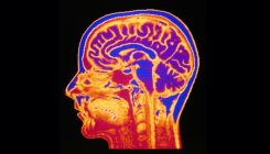 [:es]Geneticists are starting to unravel evolution’s role in mental illness[:]