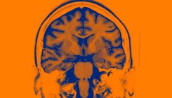 [:es]AI-controlled brain implants for mood disorders tested in people[:]