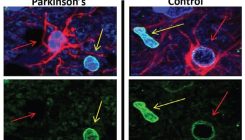[:es]Flushing out ‘zombie cells’ could help stave off Parkinson’s[:]