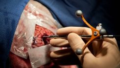 [:es]La sonda que quiere revolucionar las cirugías oncológicas[:]