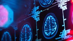 [:es]Alzheimer’s setback as promising drug shows no benefit in clinical trials[:]