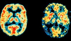 [:es]’Surprising’ study suggests exercise may make dementia worse[:]