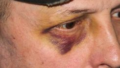 [:es]¿Por qué los hematomas cambian de color?[:]