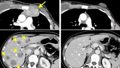 [:es]Eliminan el cáncer de mama gracias a las células T de la propia paciente[:]