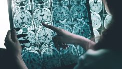 [:es]Alzhéimer: cada vez más evidencias apuntan al virus del herpes como posible causa[:]