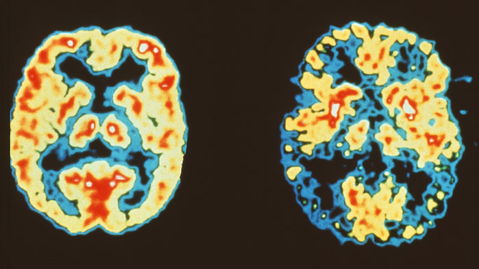 [:es]‘Landmark study’ shows brain cells revamp their DNA, perhaps sparking Alzheimer’s disease[:]