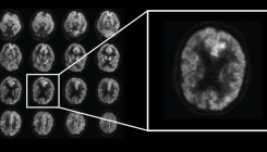 [:es]Una Inteligencia Artificial para predecir el alzhéimer años antes de su aparición[:]
