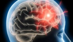 [:es]Migrainak zein mekanismoren bidez sortzen diren identifikatu dute[:]