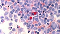 [:es]Identificado un mecanismo que explica por qué algunos pacientes de cáncer tratados con éxito desarrollan leucemia años después[:]