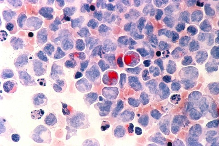 [:es]Identificado un mecanismo que explica por qué algunos pacientes de cáncer tratados con éxito desarrollan leucemia años después[:]