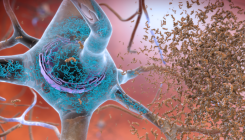 [:es]Another major drug candidate targeting the brain plaques of Alzheimer’s disease has failed. What’s left?[:]