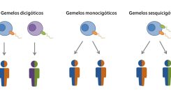 [:es]Descrito el segundo caso de gemelos sesquicigóticos, primero en detectarse durante el embarazo[:]