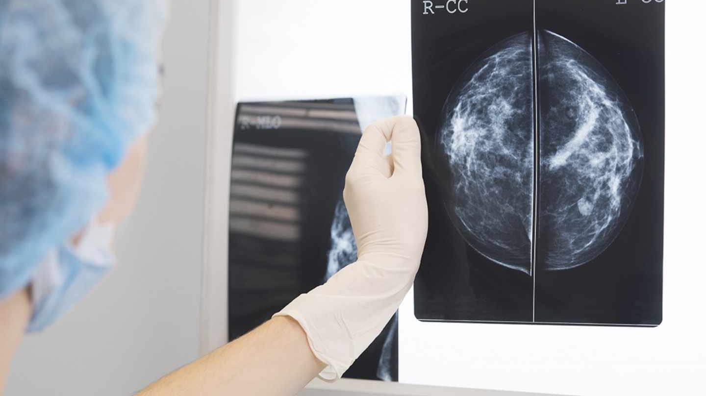 [:es]Una IA pronostica cáncer de mama sin sesgos de raza[:]