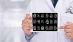 [:es] Identifican tres categorías de genes implicadas en el alzhéimer [:]