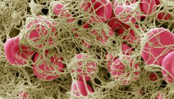 [:es]Coronavirus blood-clot mystery intensifies[:]