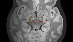 [:es]Brain stimulation needs to be precise[:]