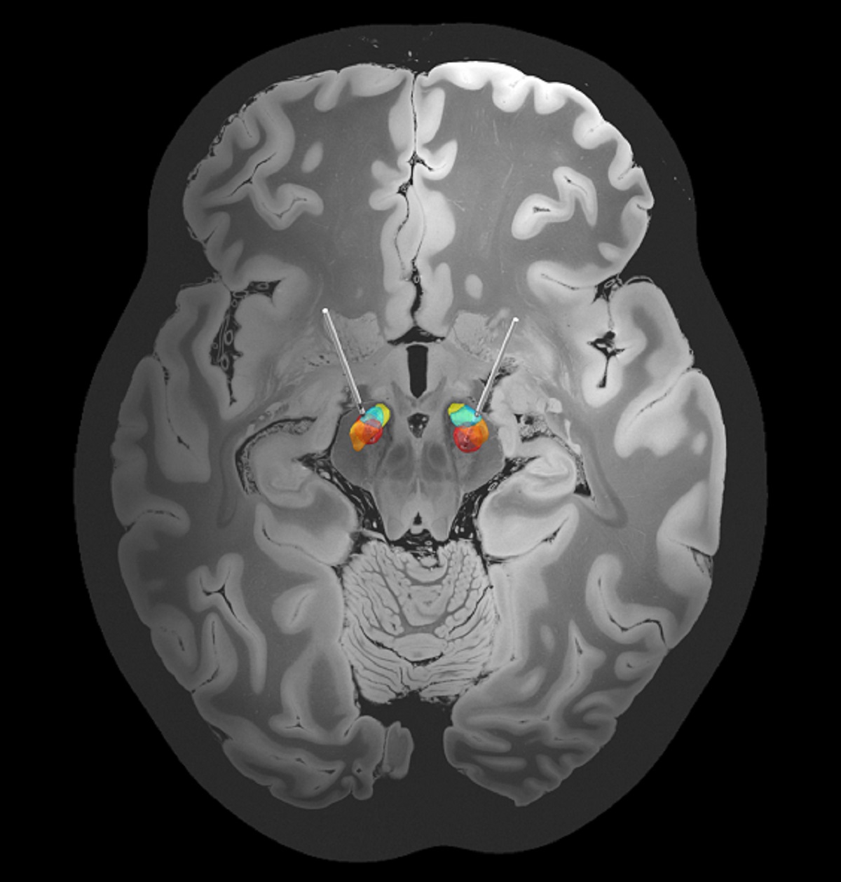 [:es]Brain stimulation needs to be precise[:]