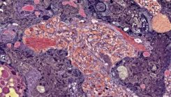 [:es]Landmark Alzheimer’s drug approval confounds research community[:]