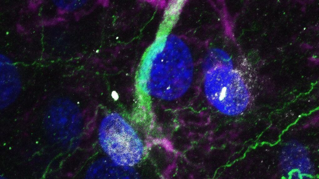 [:es] Las enfermedades neurodegenerativas atacan a las células madre del cerebro [:]