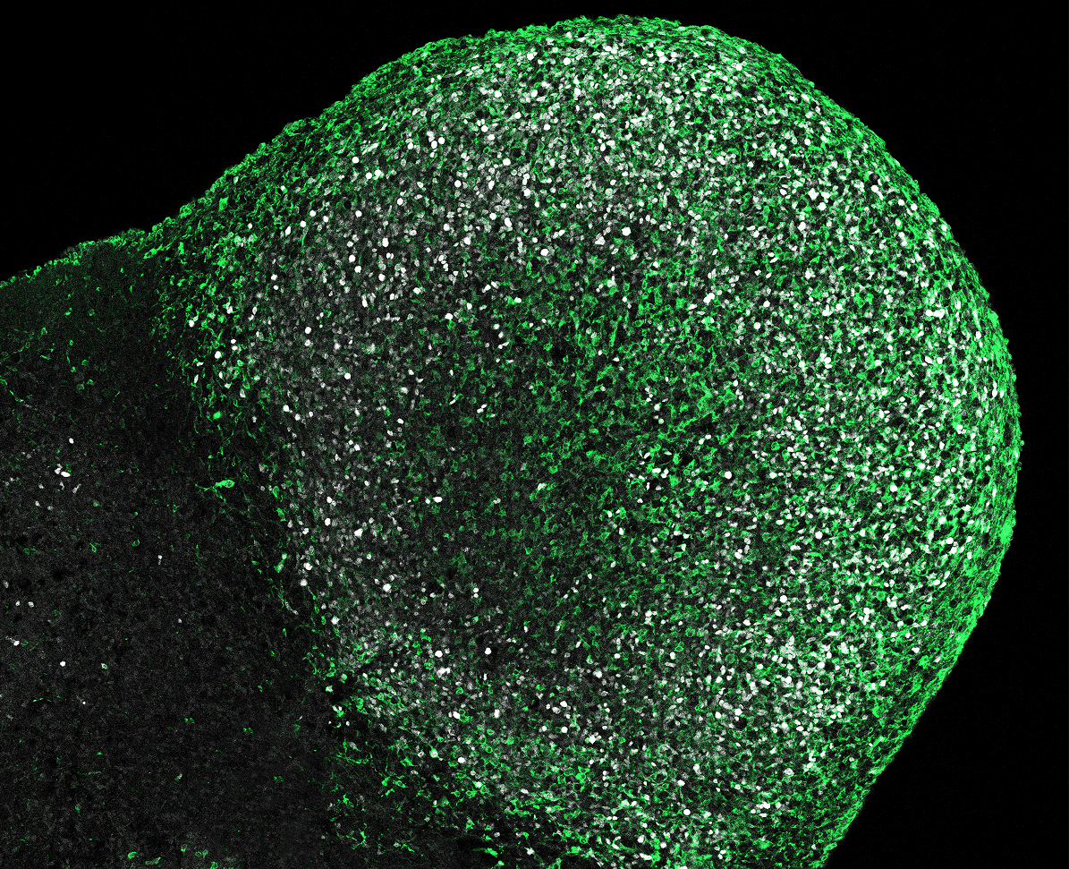 [:es]Los organoides cerebrales desvelan nuevas causas de la esclerosis tuberosa[:]