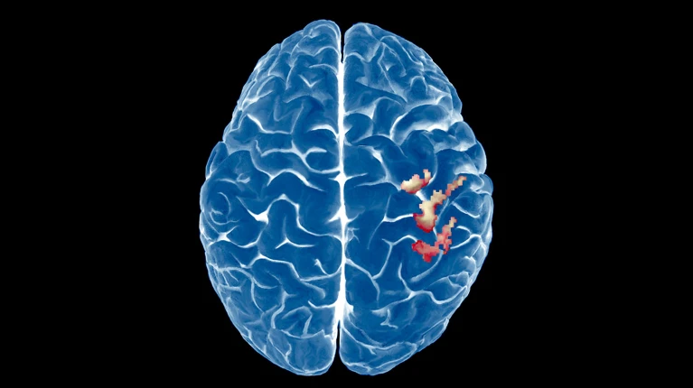 The brain’s map of the body is surprisingly stable — even after a limb is lost