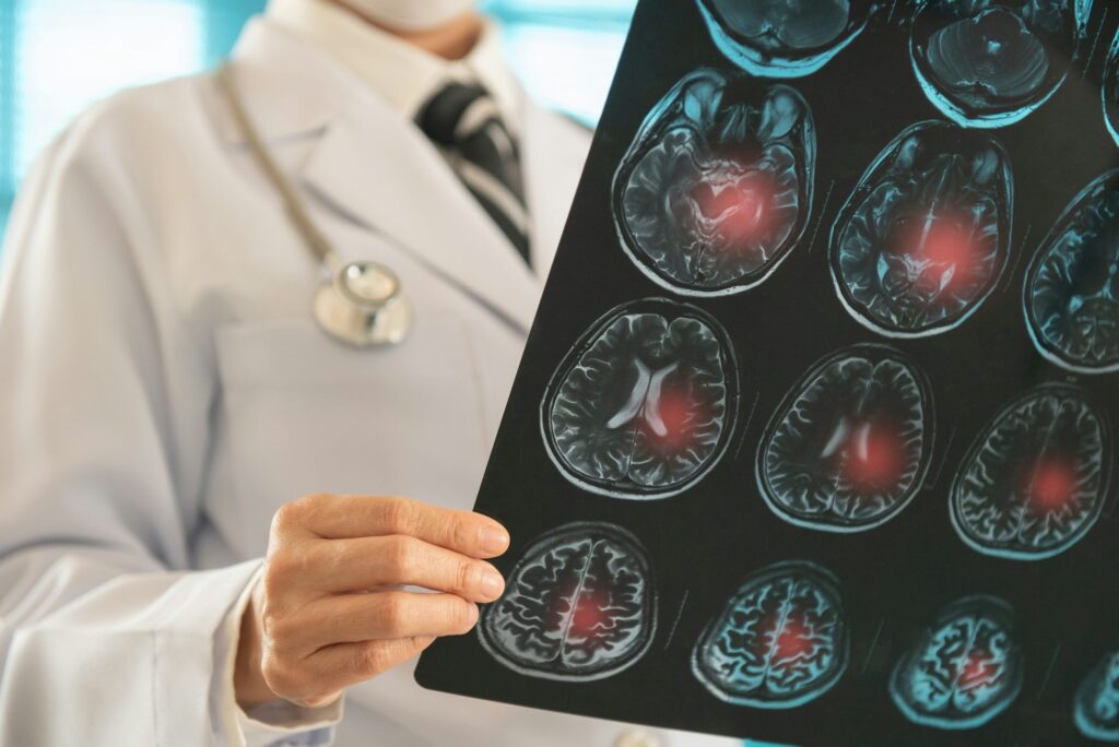 Terapia con células madre: ¿una nueva era en la regeneración cerebral después de un ictus?